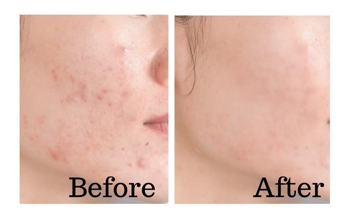 ミレム　ビュートリックの使用前使用後①